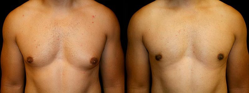 Gynecomastia Patient 20 Before & After