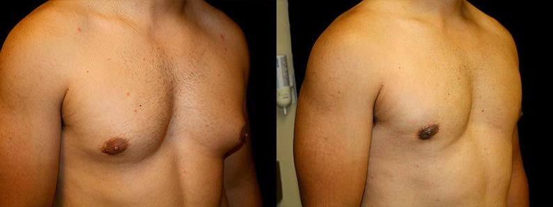 Gynecomastia Patient 20 Before & After Details