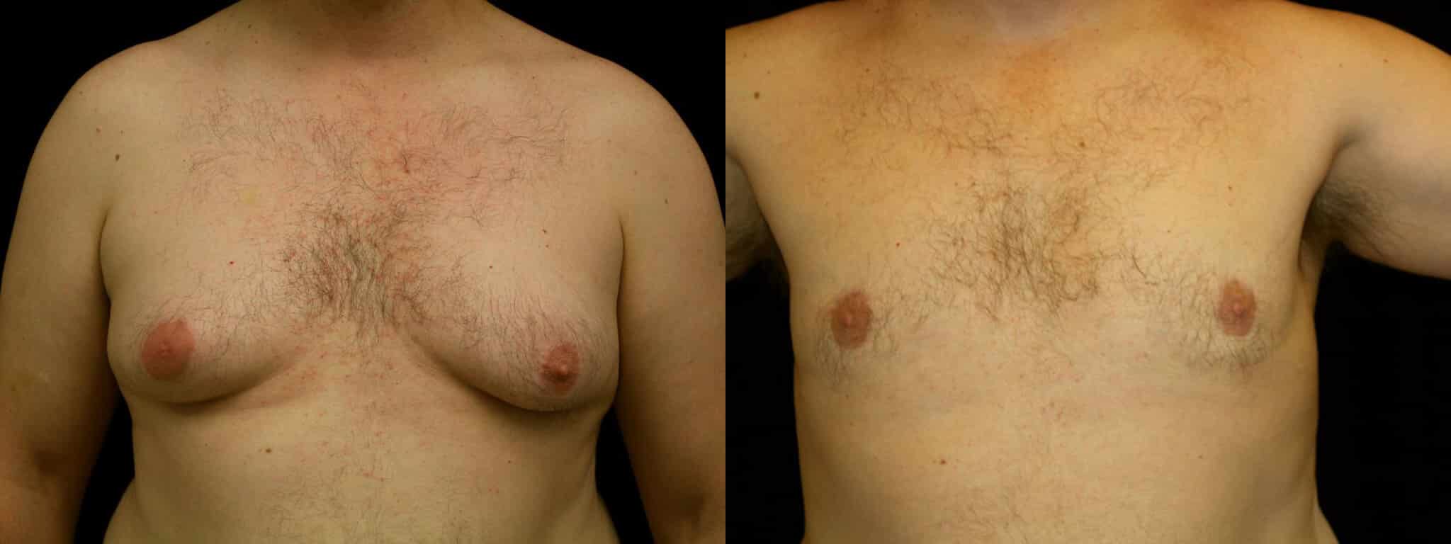 Gynecomastia Patient 11 Before & After