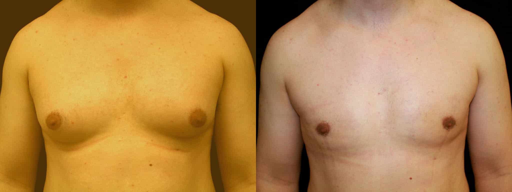 Gynecomastia Patient 5 Before & After