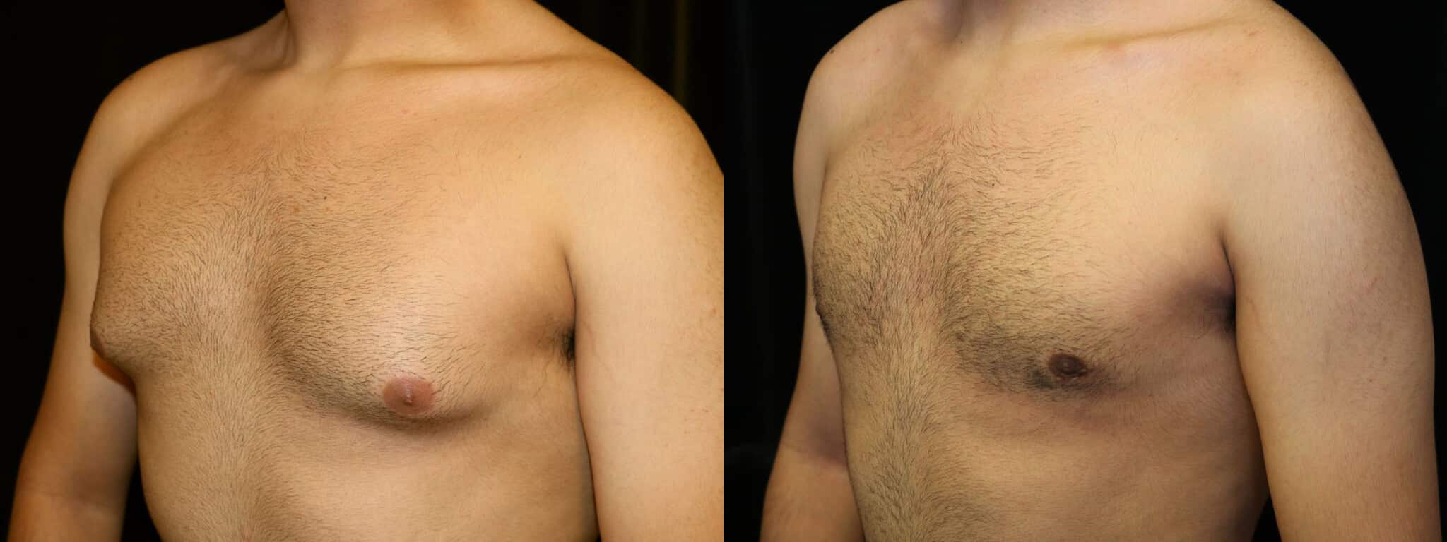 Gynecomastia Patient 13 Before & After Details