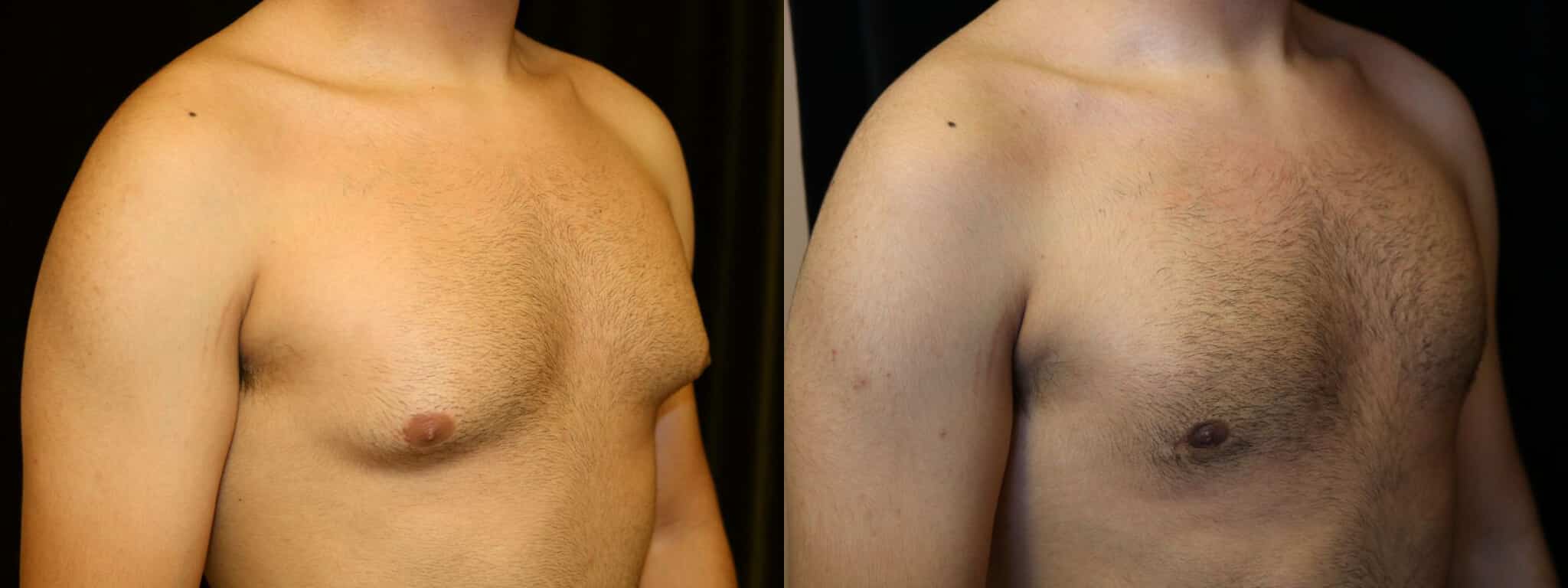 Gynecomastia Patient 13 Before & After Details