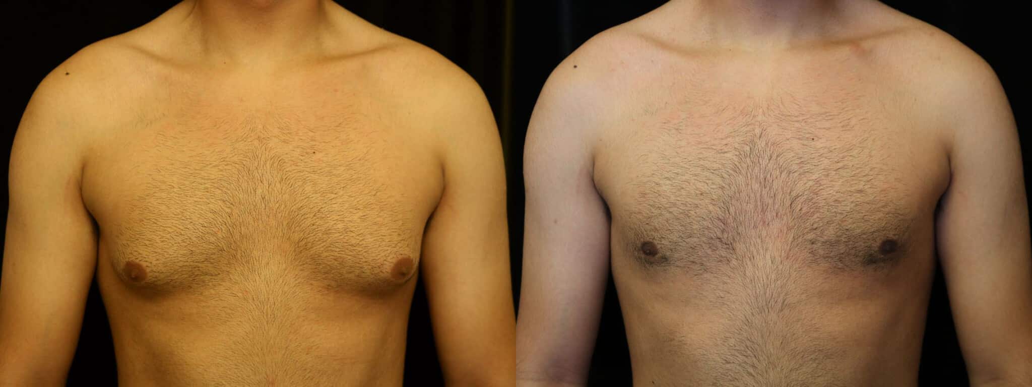 Gynecomastia Patient 13 Before & After