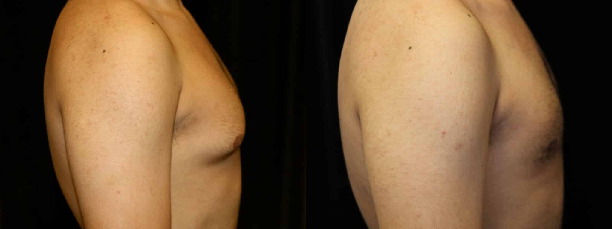 Gynecomastia Patient 13 Before & After Details