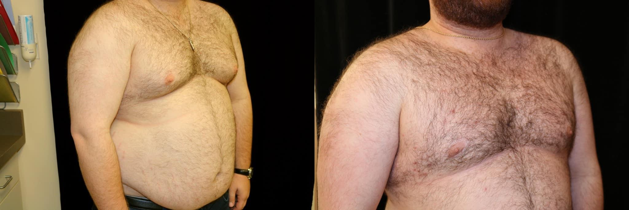 Gynecomastia Patient 21 Before & After