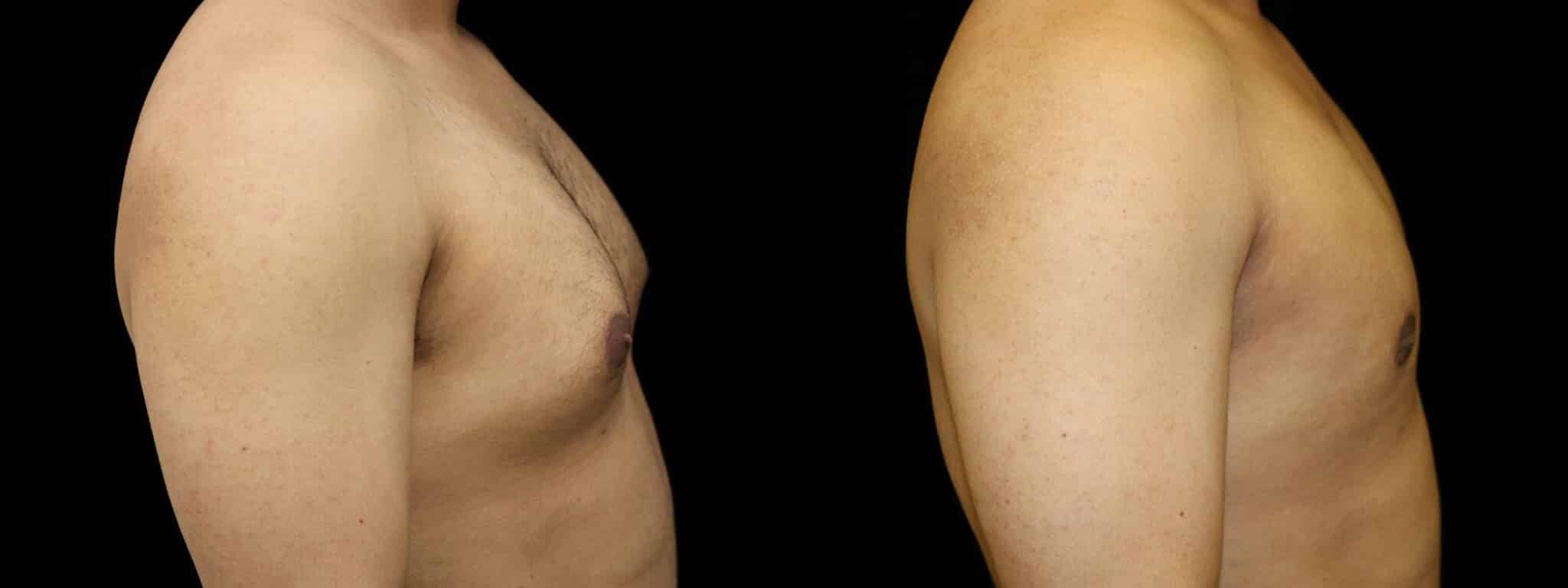 Gynecomastia Patient 20 Before & After Details