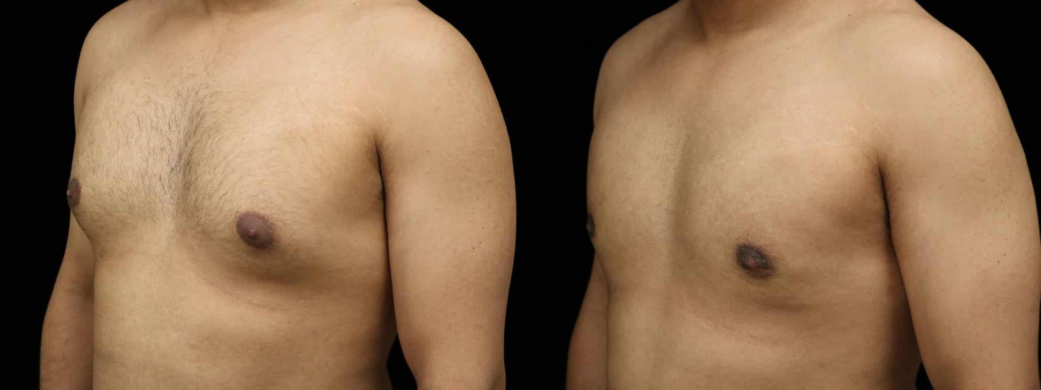 Gynecomastia Patient 20 Before & After Details