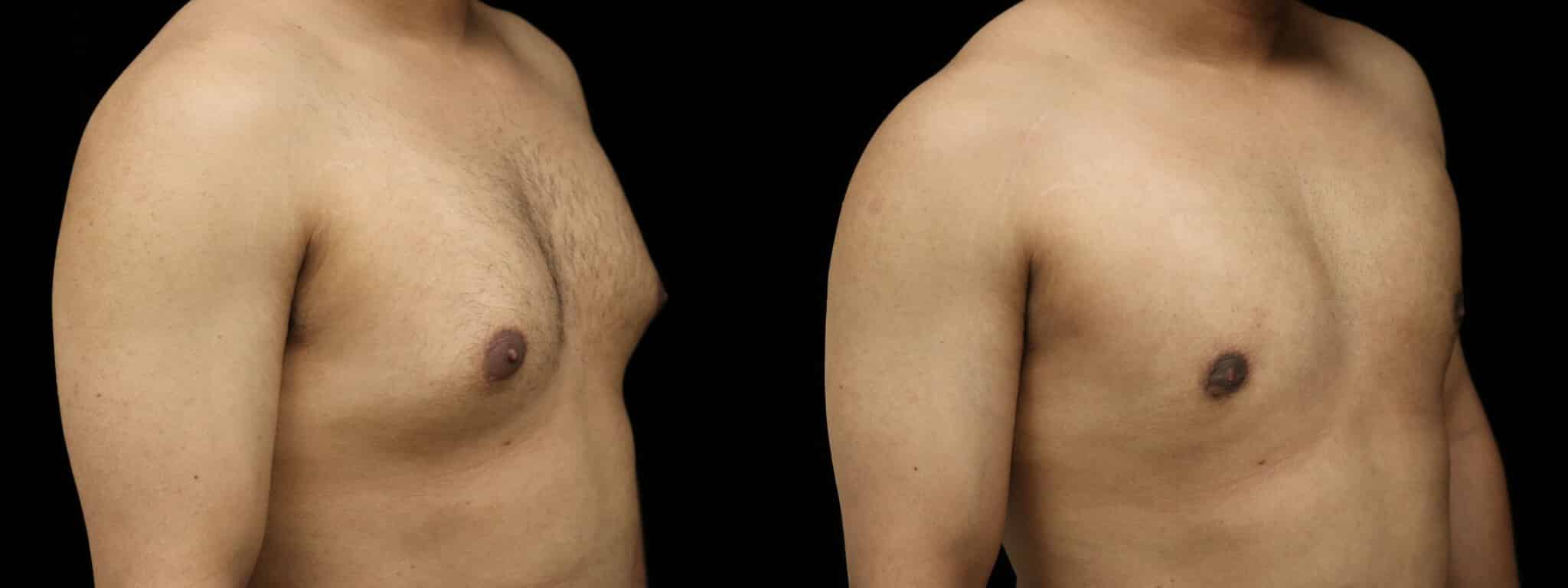 Gynecomastia Patient 20 Before & After Details