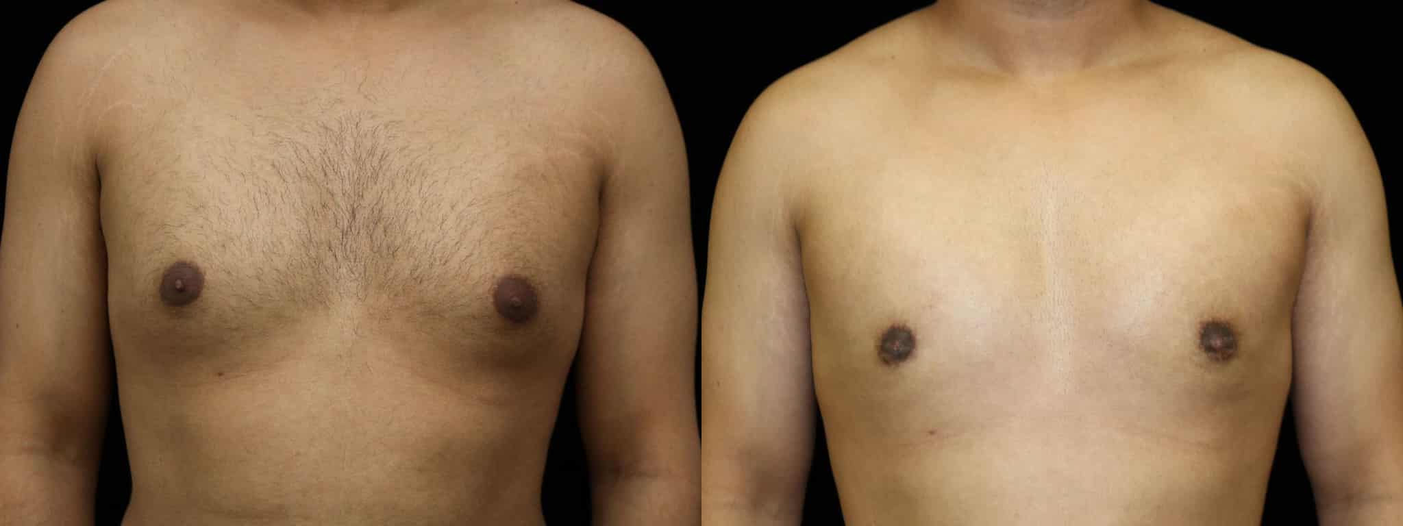 Gynecomastia Patient 20 Before & After