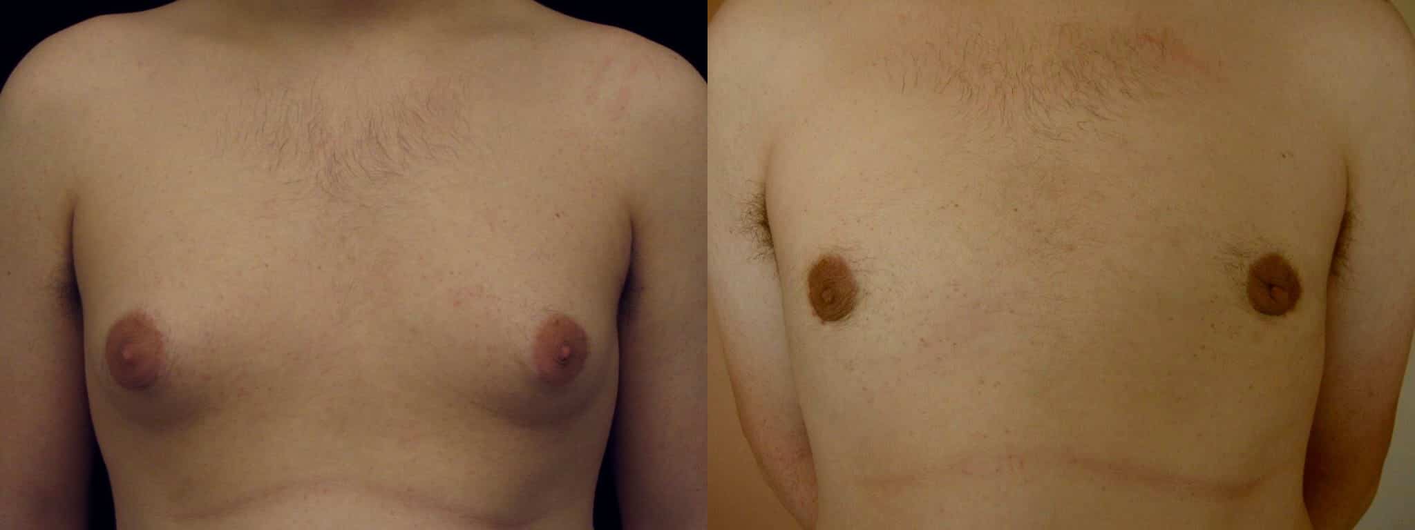 Gynecomastia Patient 10 Before & After