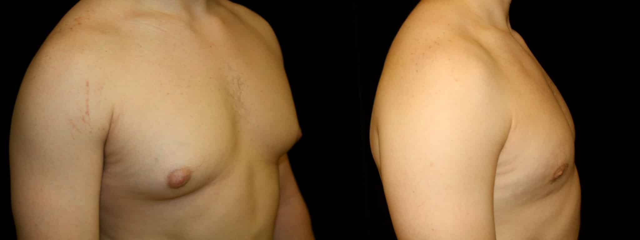 Gynecomastia Patient 15 Before & After Details