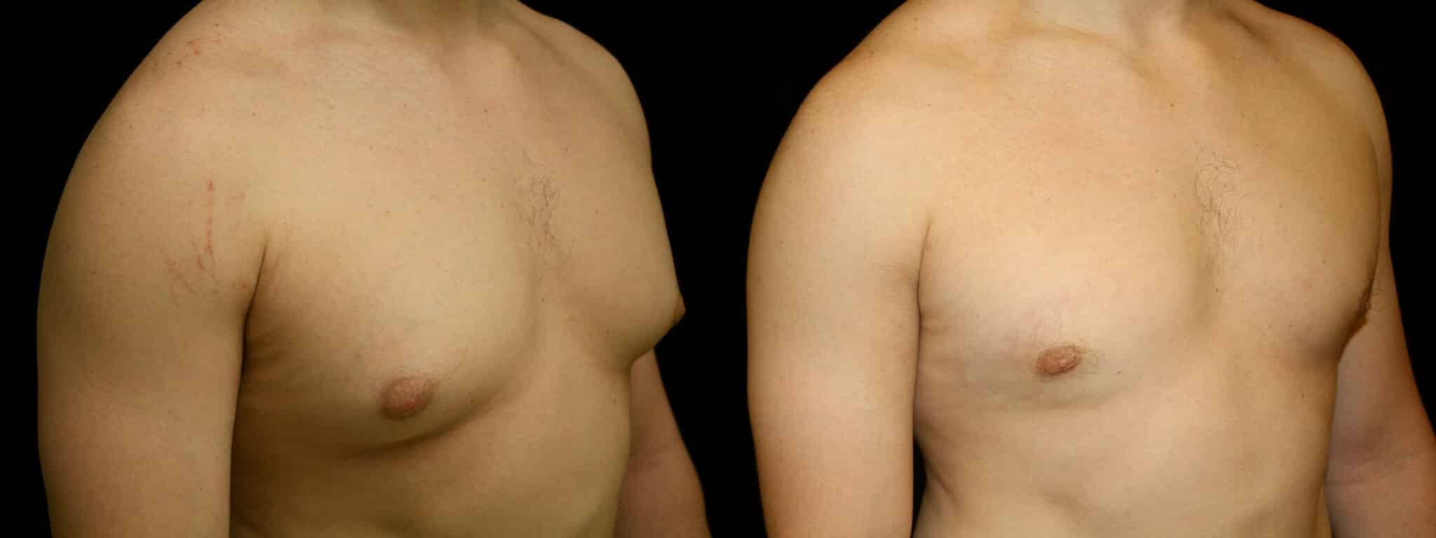 Gynecomastia Patient 15 Before & After