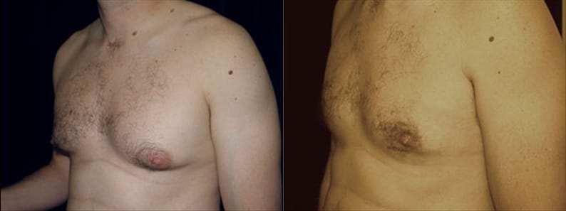 Gynecomastia Patient 8 Before & After Details