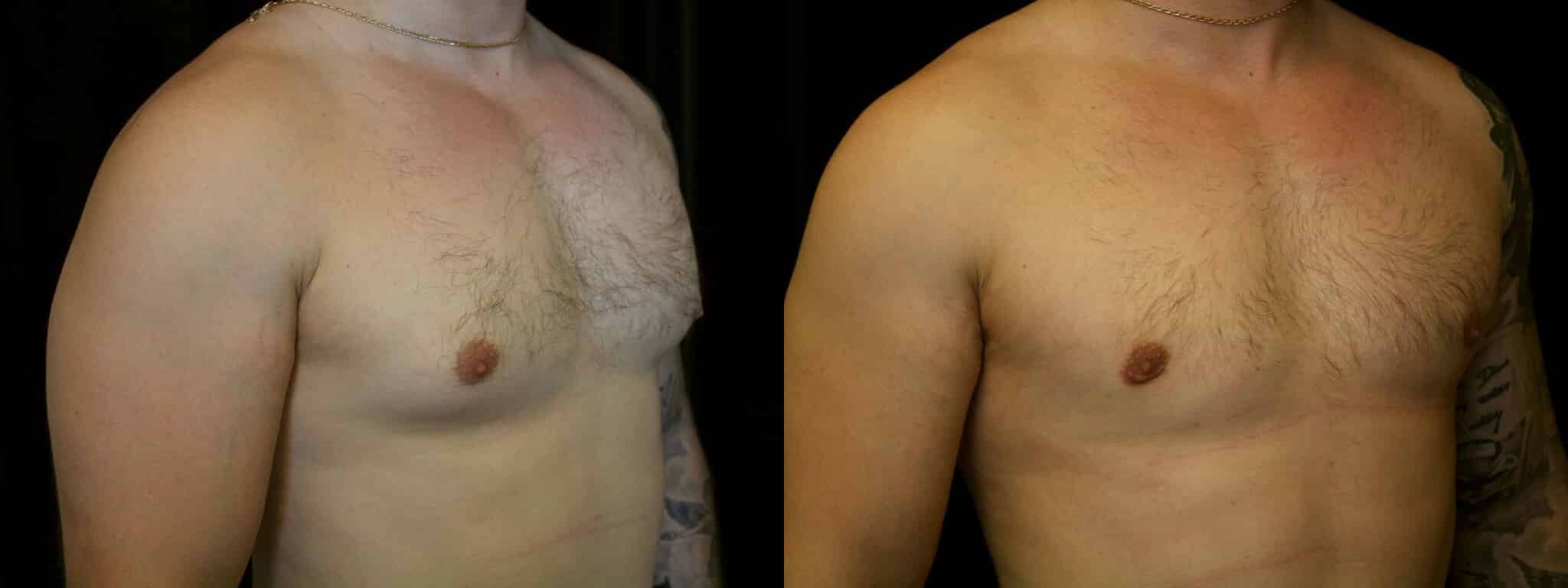 Gynecomastia Patient 16 Before & After Details