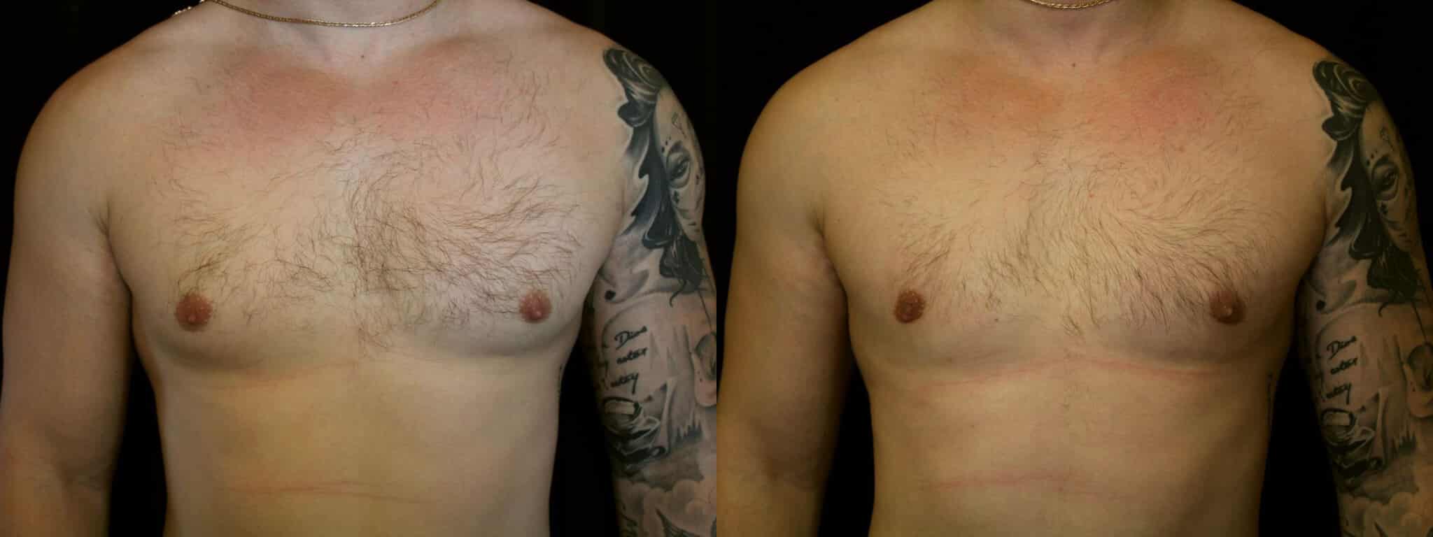 Gynecomastia Patient 16 Before & After