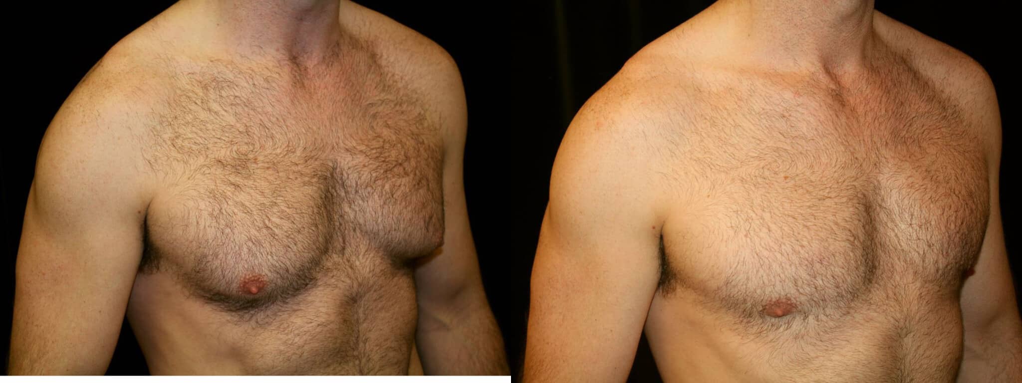 Gynecomastia Patient 8 Before & After