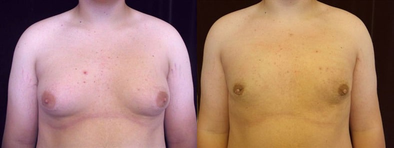 Gynecomastia Patient 1 Before & After