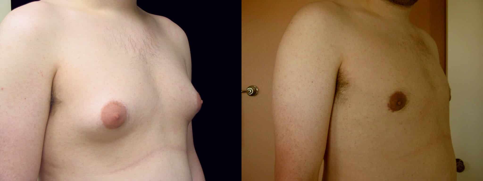 Gynecomastia Patient 10 Before & After Details