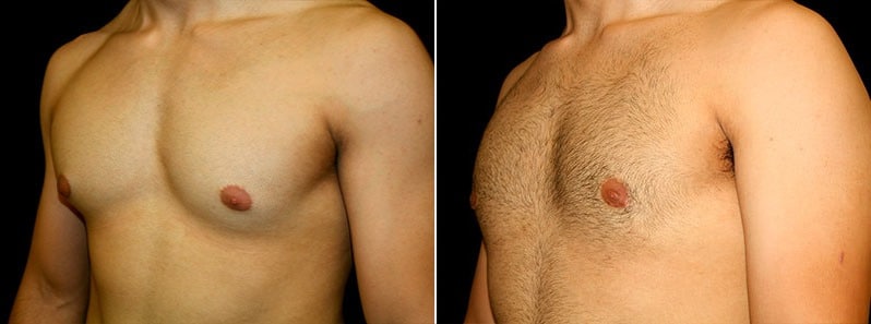 Gynecomastia Patient 14 Before & After Details