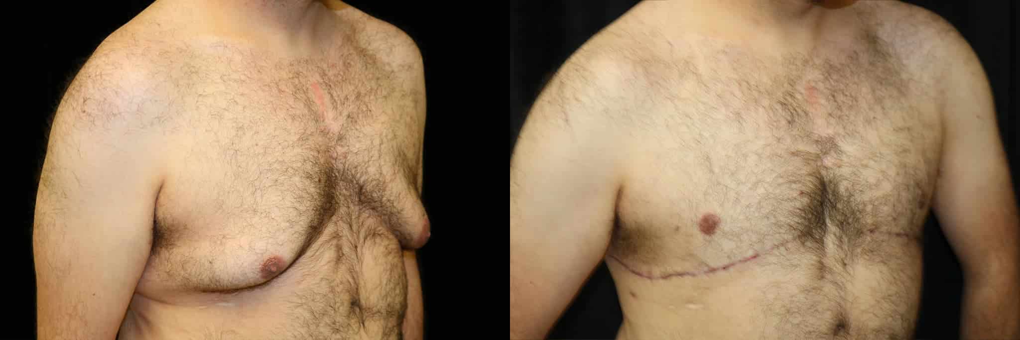 Gynecomastia Patient 3 Before & After Details