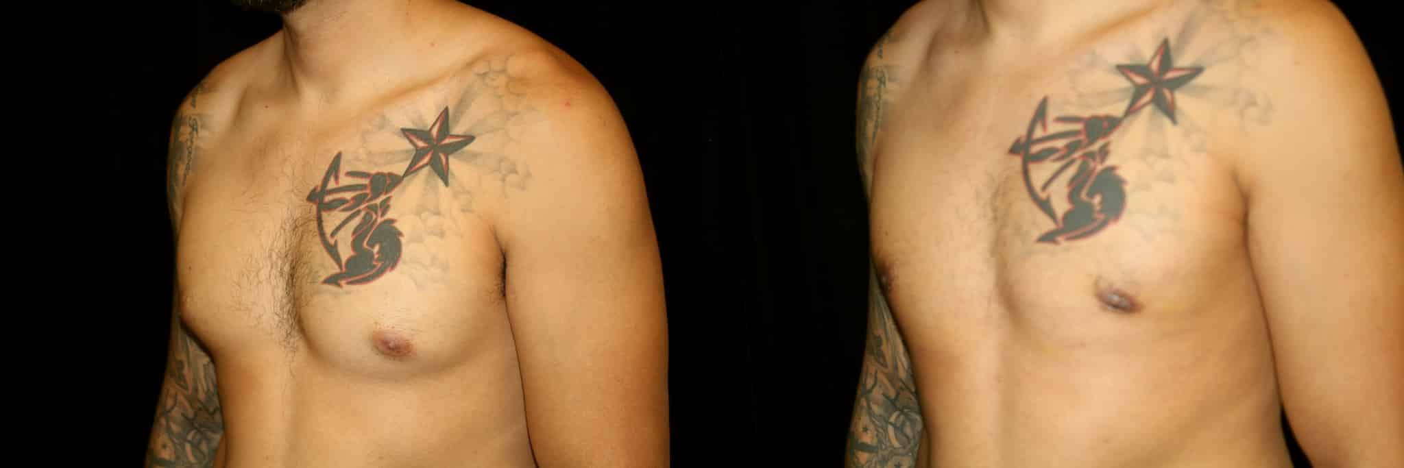 Gynecomastia Patient 18 Before & After Details