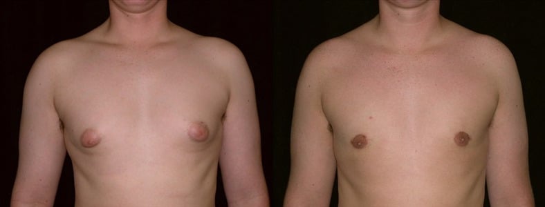 Gynecomastia Patient 14 Before & After