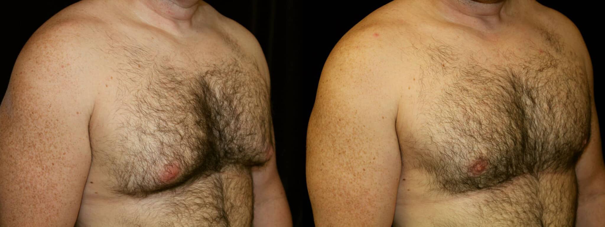 Gynecomastia Patient 6 Before & After Details