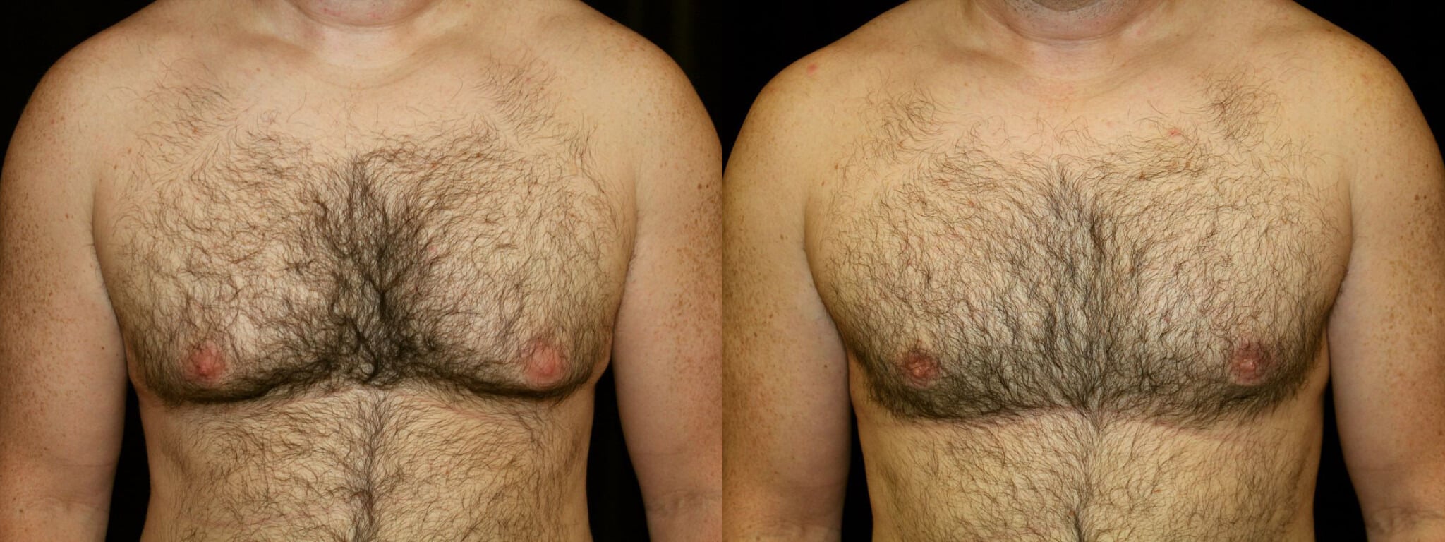 Gynecomastia Patient 6 Before & After