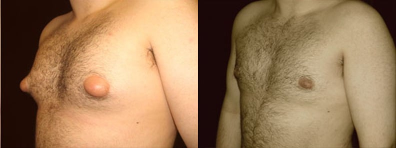 Gynecomastia Patient 3 Before & After Details