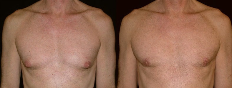 Gynecomastia Patient 1 Before & After