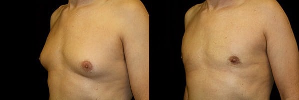 Gynecomastia Patient 18 Before & After Details