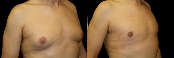 Gynecomastia Patient 18 Before & After Details