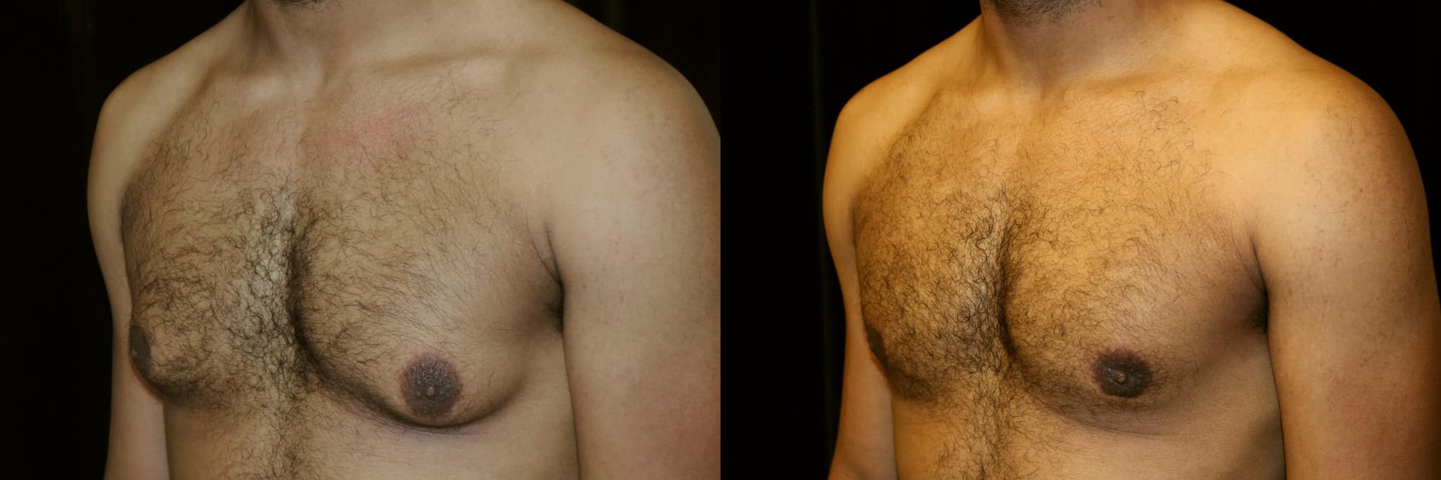 Gynecomastia Patient 14 Before & After Details