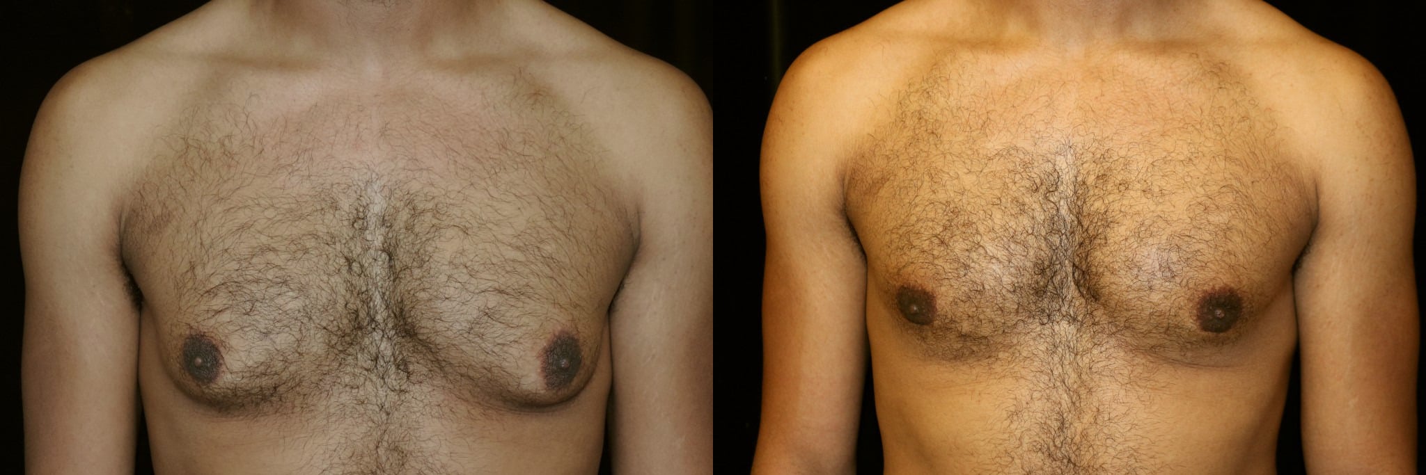 Gynecomastia Patient 14 Before & After