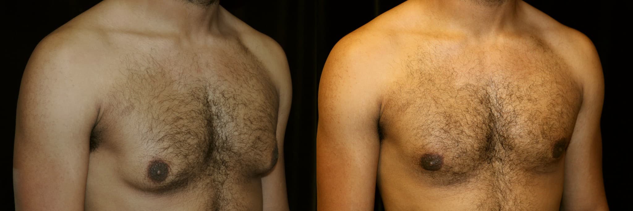 Gynecomastia Patient 14 Before & After Details