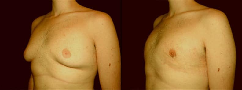 Gynecomastia Patient 15 Before & After Details