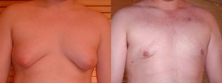 Gynecomastia Patient 12 Before & After