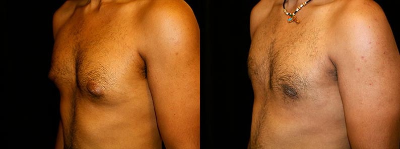 Gynecomastia Patient 17 Before & After Details