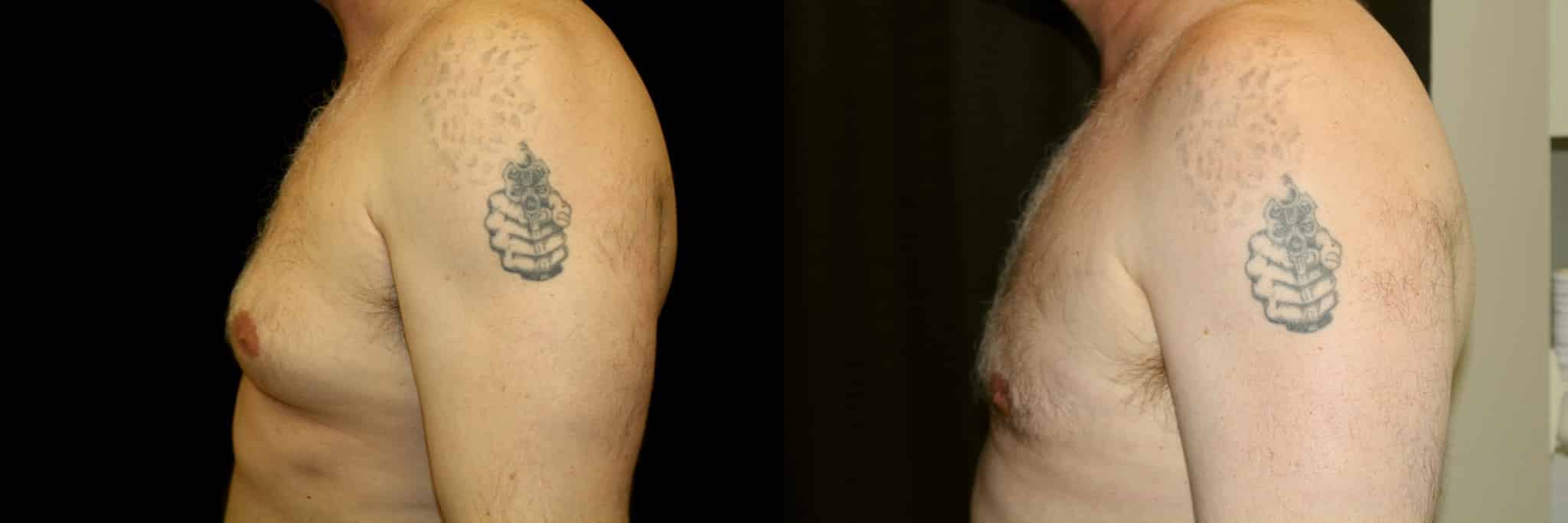 Gynecomastia Patient 19 Before & After Details