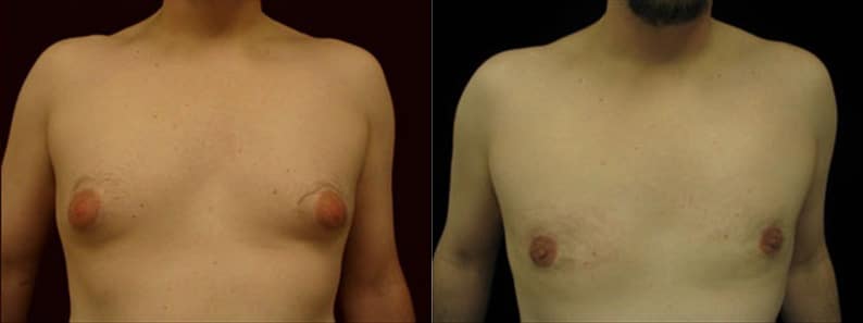 Gynecomastia Patient 18 Before & After