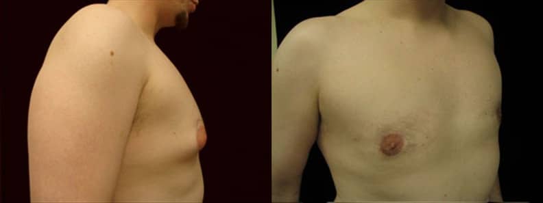 Gynecomastia Patient 18 Before & After Details