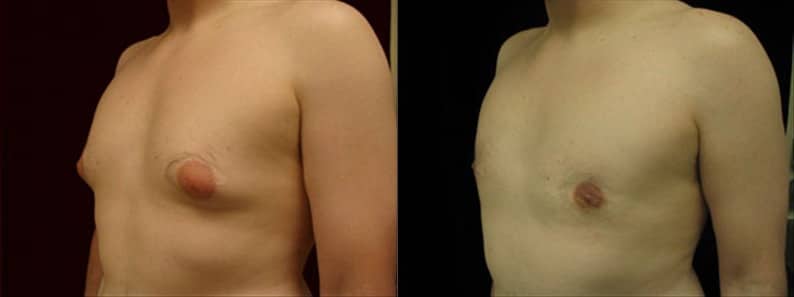 Gynecomastia Patient 18 Before & After Details