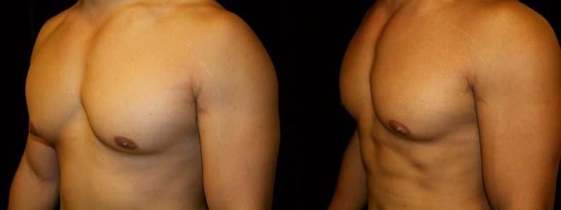 Gynecomastia Patient 11 Before & After Details