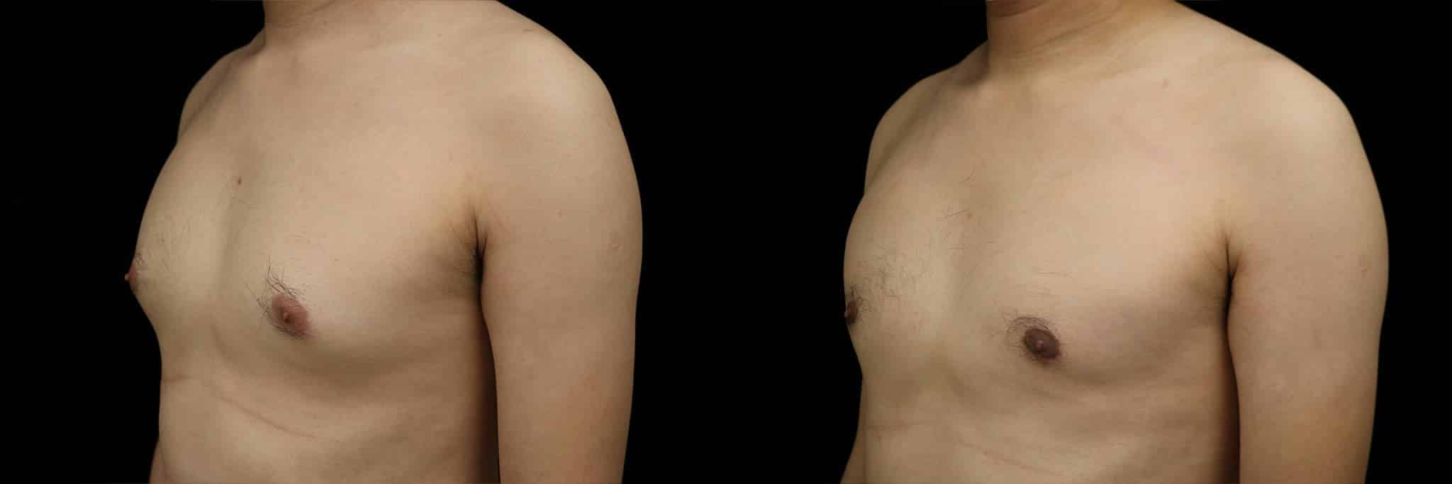 Gynecomastia Patient 17 Before & After Details