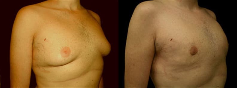 Gynecomastia Patient 15 Before & After Details