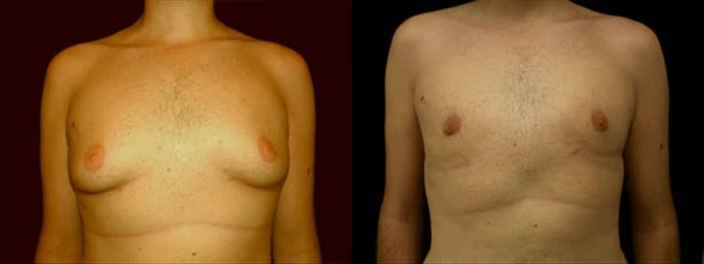 Gynecomastia Patient 15 Before & After