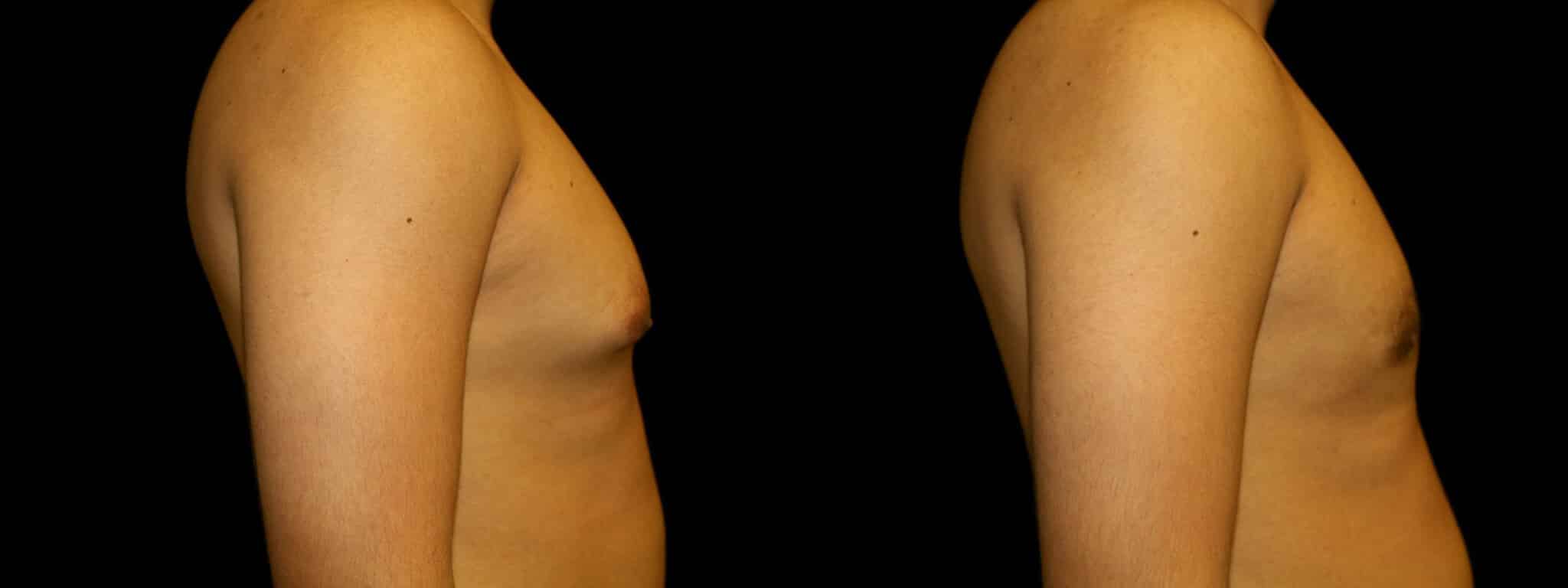 Gynecomastia Patient 20 Before & After Details