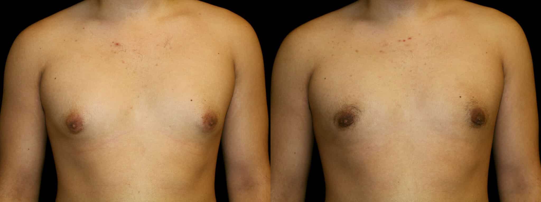 Gynecomastia Patient 20 Before & After