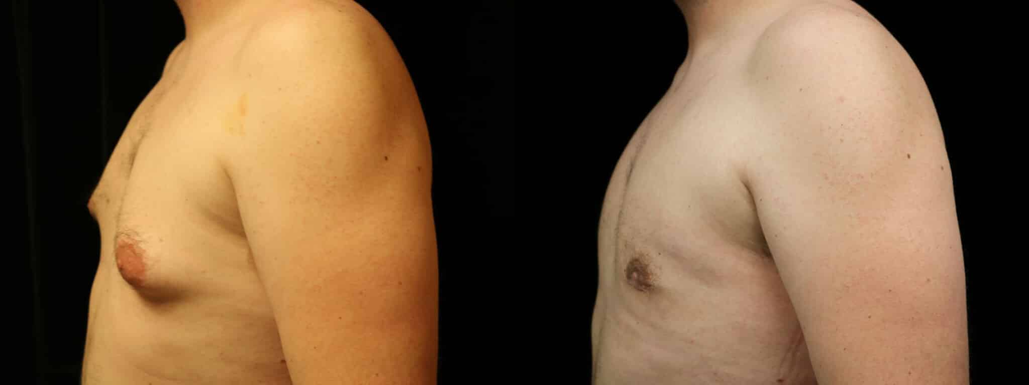 Gynecomastia Patient 15 Before & After Details