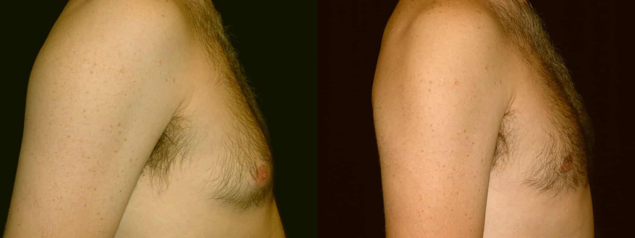 Gynecomastia Patient 3 Before & After Details